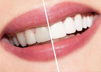 Teeth Whitening, Wolverhampton