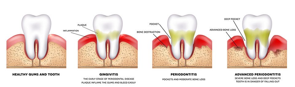 Periodontal Gum Treatment, Wolverhampton