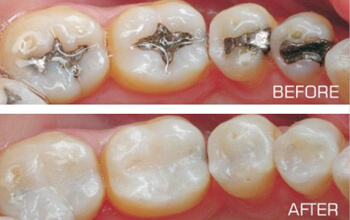 Tooth Coloured Fillings, Wolverhampton