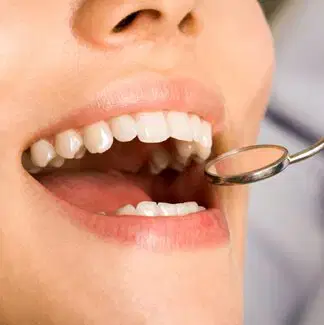 Oral Health Examination Dental mirror inside an open mouth during an oral examination