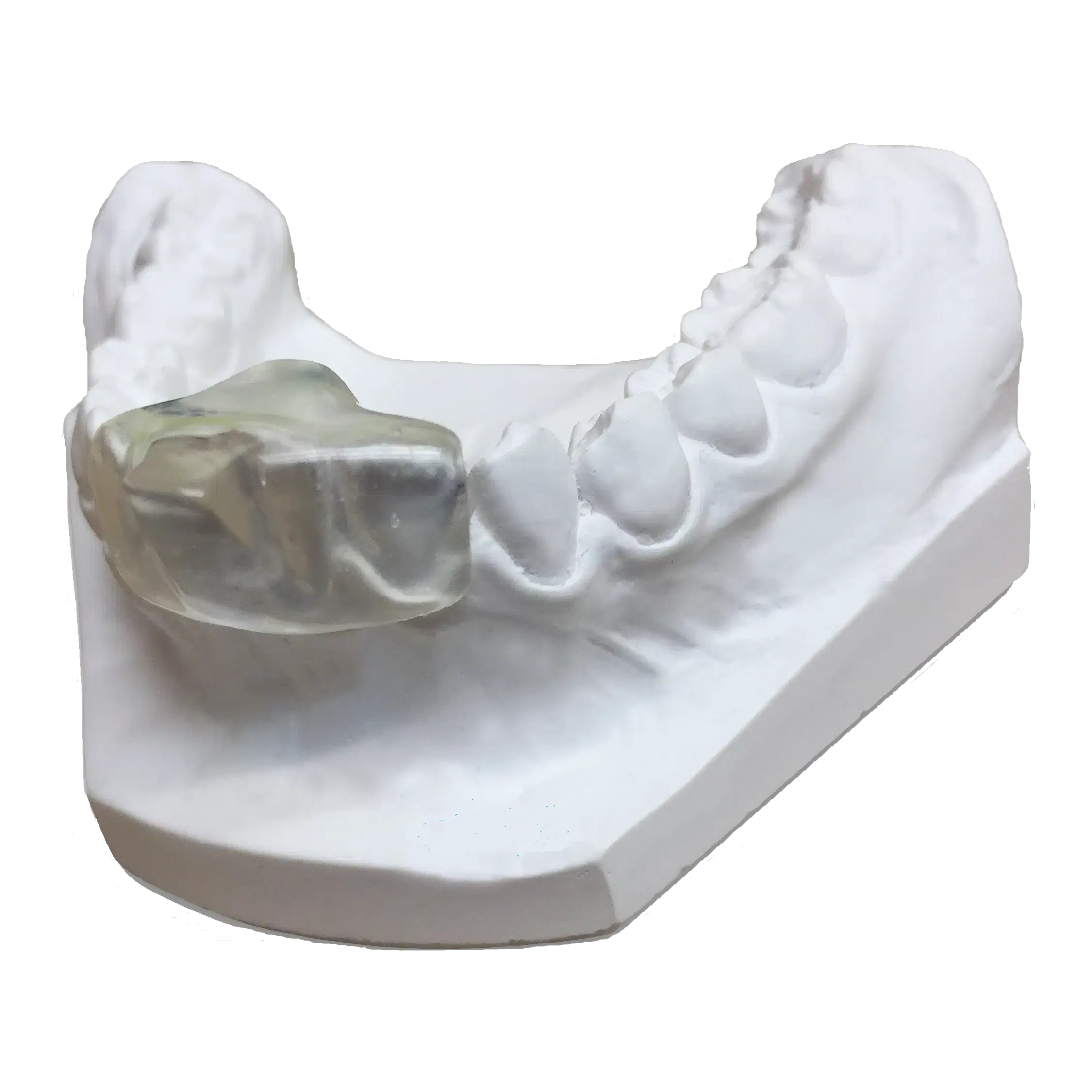 Dental Splint for Teeth Grinding and Bruxism Dental splint used to protect teeth from grinding and clenching